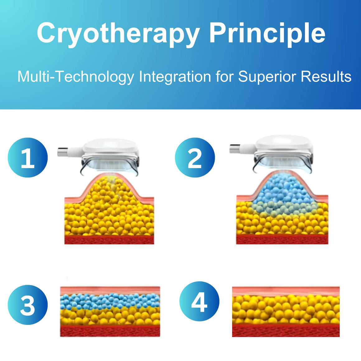 Cryotherapy Principle
