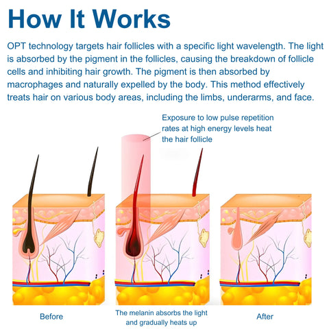 IPL-OPT-Laser-Hair-Removal-Machine_4