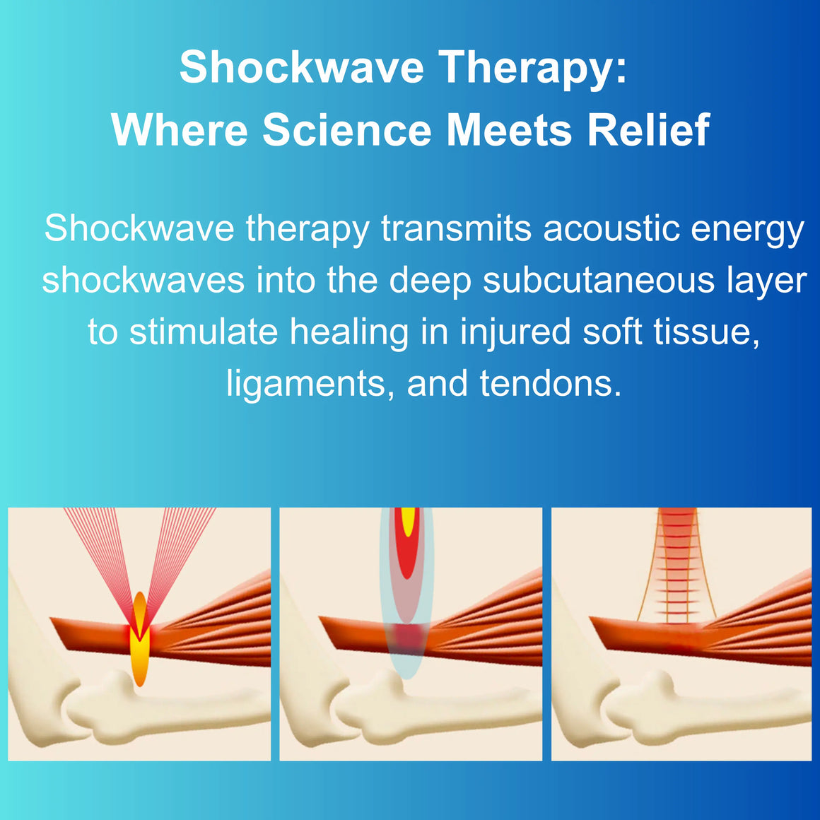 Shockwave Math Shockwave Therapy: Where Science Meets Relief